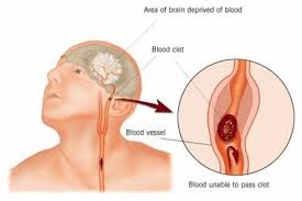 Cara Pengobatan Penyempitan Pembuluh Darah Di Otak